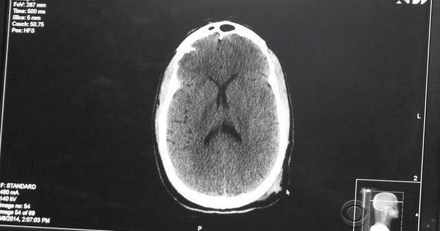 A promising new way to diagnose concussions