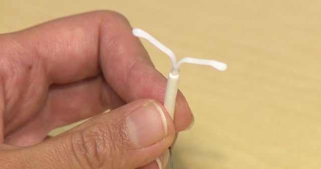 Hormonal IUDs could last longer than thought