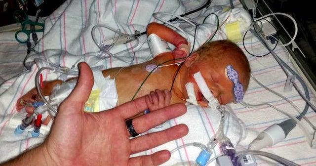 Six-day old newborn survives rare heart surgery