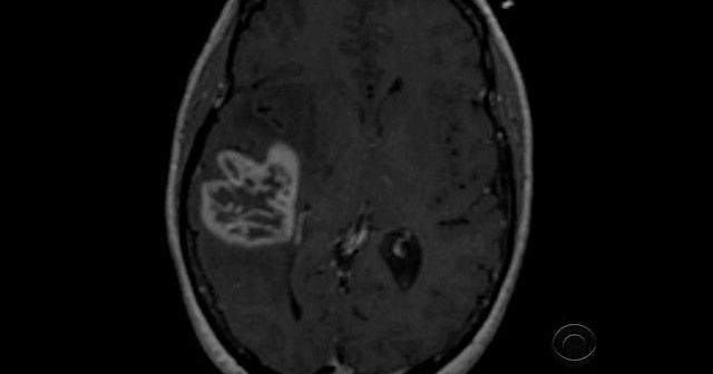 Experimental cancer therapy shown to dramatically prolong life