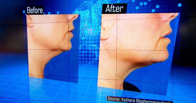FDA approves non-surgical treatment to melt double chin fat