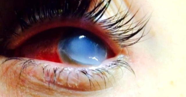 Infection from mud run leaves woman blind in one eye