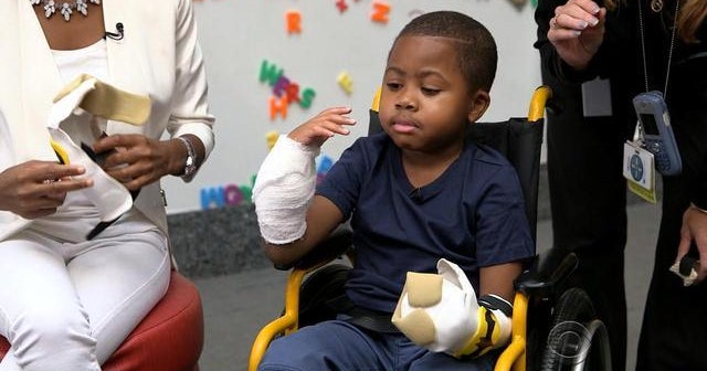 8-year old gets double-hand transplant