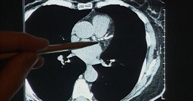 Heart disease deaths decline, but not equally