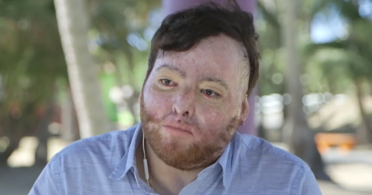 Man billed $1.7 million by government for life-saving burn treatment