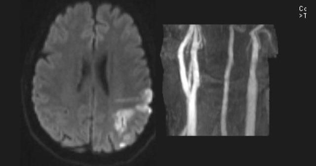 Stroke can strike at any age