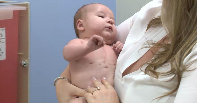 Baby thrives after heart procedure before birth