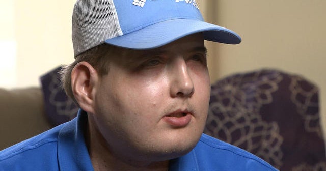 Face transplant recipient: Normal has become a reality