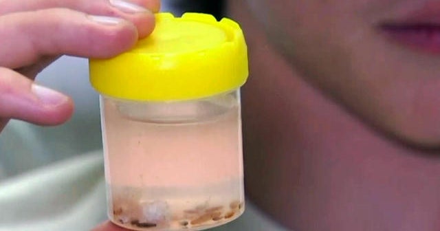 Teen's legs attacked by tiny parasites