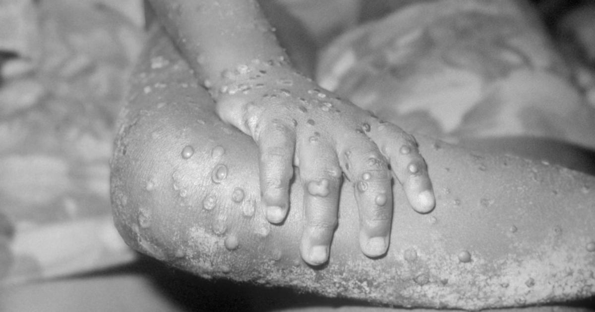Texas patient becomes U.S.' first monkeypox case since 2003