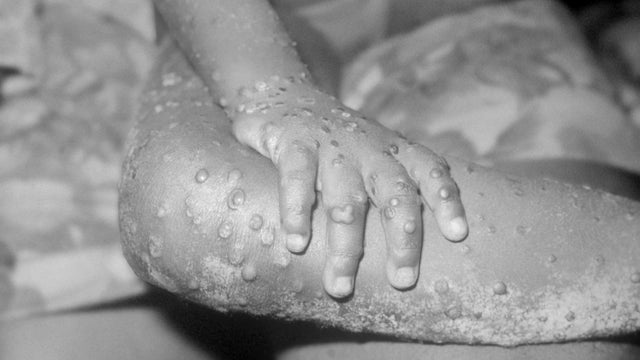 Monkeypox Virus 