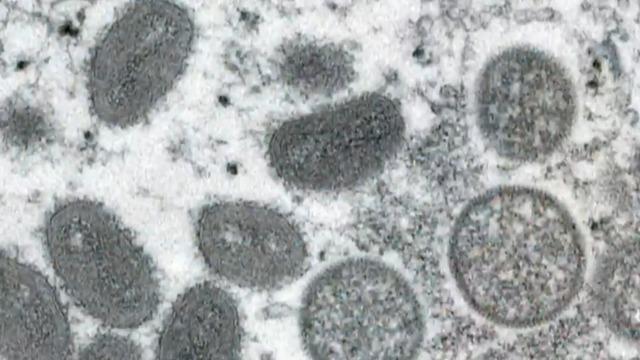 cbsn-fusion-more-monkeypox-cases-reported-in-us-thumbnail-1026405-640x360.jpg 